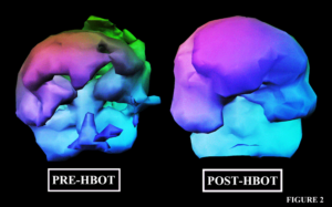 Traumatic Brain Injury