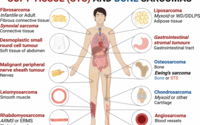 Healing Sarcoma: HBOT’s Role in Radiation Recovery
