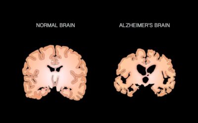 Alzheimer’s Disease, Brain Health, and the Potential of Oxygen Therapy
